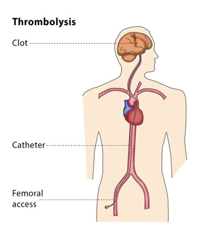 Тромболизис это. Катетер-управляемый тромболизис. Тромболизис как выглядит. Системный тромболизис рисунок.